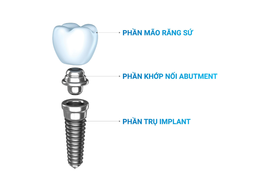 Implant cơ bản bao gồm 3 thành phần.