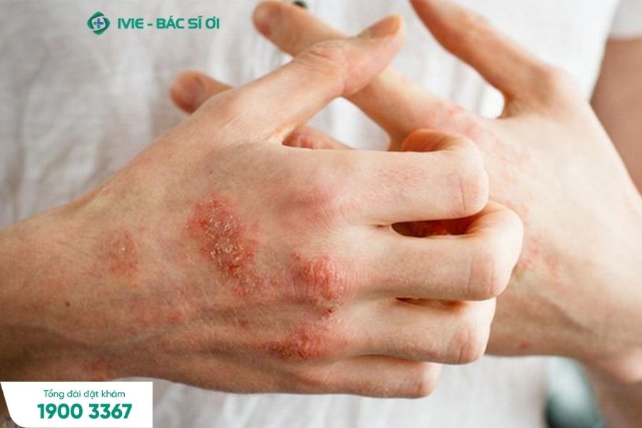   Chàm da tay là bệnh tương đối phổ biến