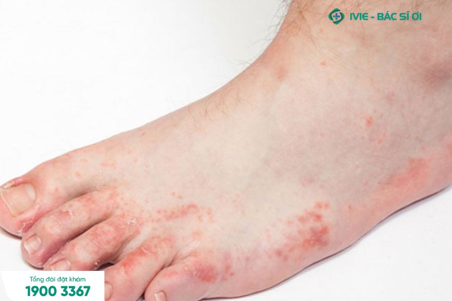 Chàm tổ đỉa thường xuất hiện dưới dạng các vết sưng, đỏ, ngứa trên da