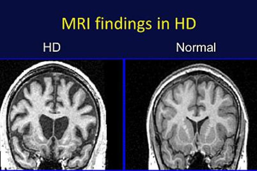 Bác sĩ có thể chỉ định chụp cắt lớp vi tính não (CT) hoặc chụp cộng hưởng từ não (MRI)