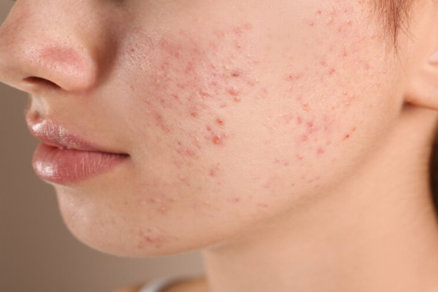 Bệnh rôm sảy chẩn đoán phân biệt với trứng cá