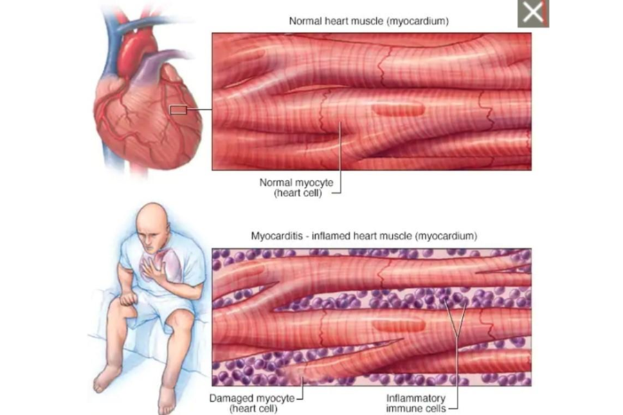 Chẩn đoán viêm cơ tim dựa vào sự phối hợp các triệu chứng và thăm dò chẩn đoán hình ảnh