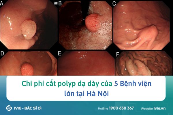 Chi phí cắt polyp dạ dày của 5 Bệnh viện lớn tại Hà Nội