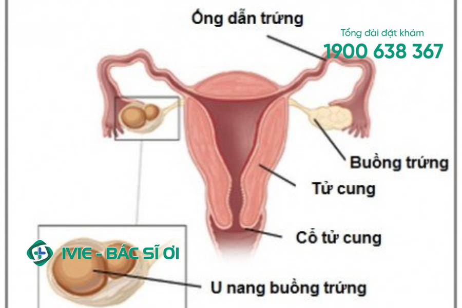 U nang buồng trứng đang ngày càng trở thành vấn đề sức khỏe đáng quan ngại của nữ giới Việt Nam