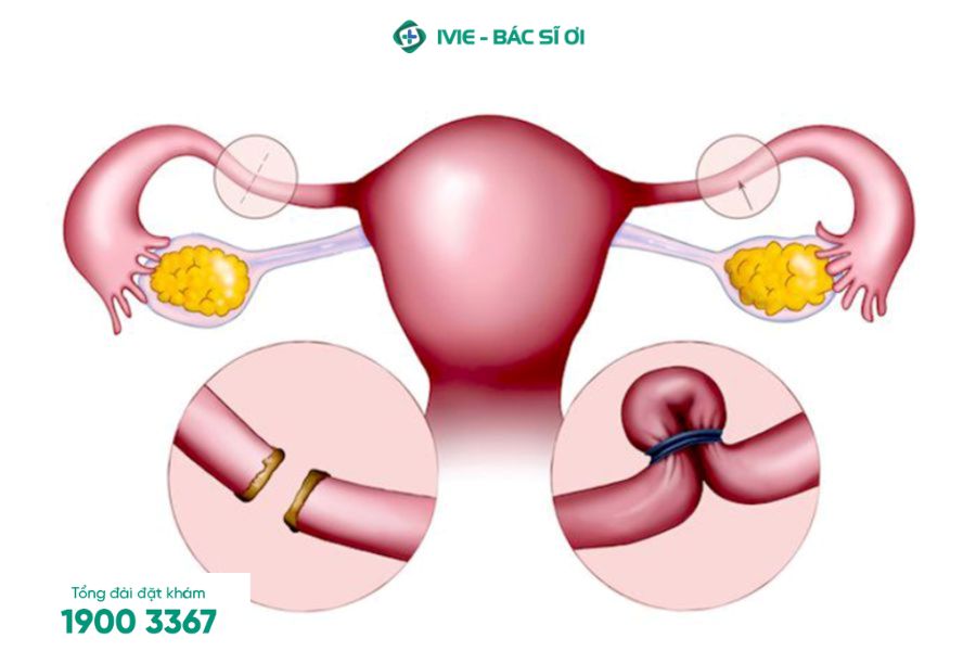 Chi phí triệt sản nữ dao động từ vài triệu đến vài chục triệu