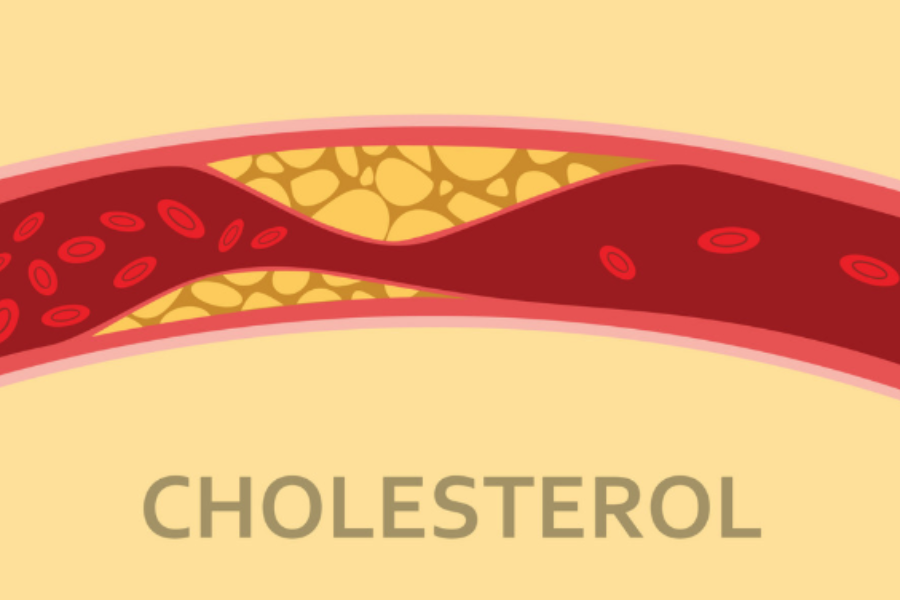 Cholesterol huyết thanh