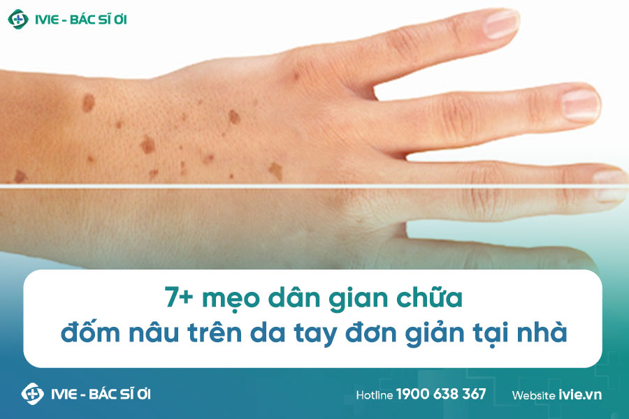 7+ mẹo dân gian chữa đốm nâu trên da tay đơn giản tại nhà