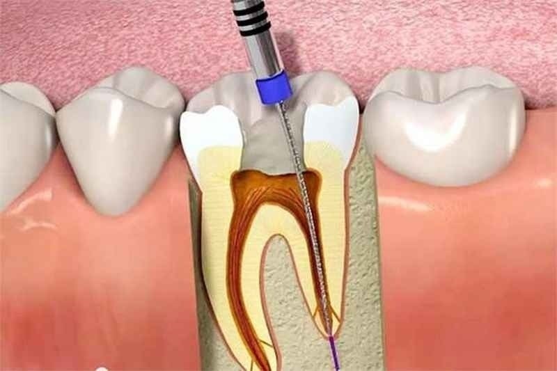 Điều trị tủy cho răng vĩnh viễn tại Phòng khám nha khoa Ngân Phượng