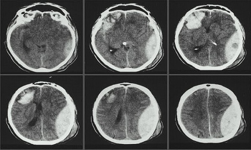 Chụp cắt lớp vi tính sọ não và những điều bạn cần biết