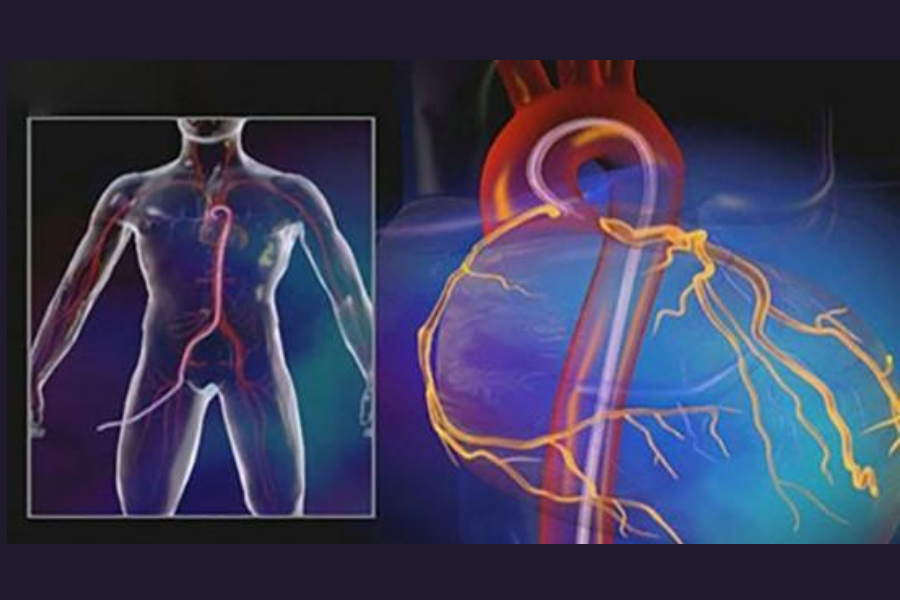 Chụp động mạch vành qua da giúp xác định chính xác tổn thương hệ động mạch vành của người bệnh