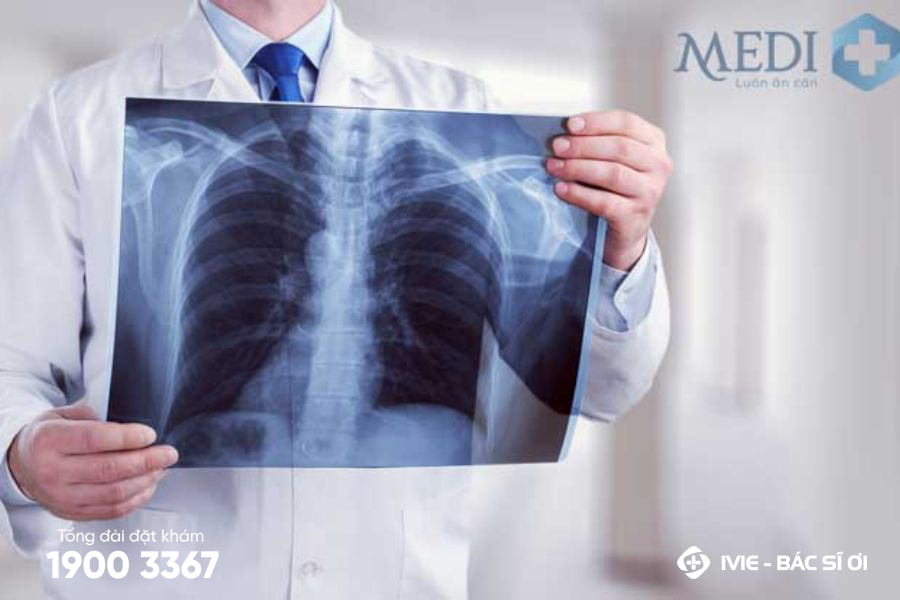 Chụp X-quang ngực tại MEDIPLUS cùng các bác sĩ Chẩn đoán hình ảnh giàu kinh nghiệm 