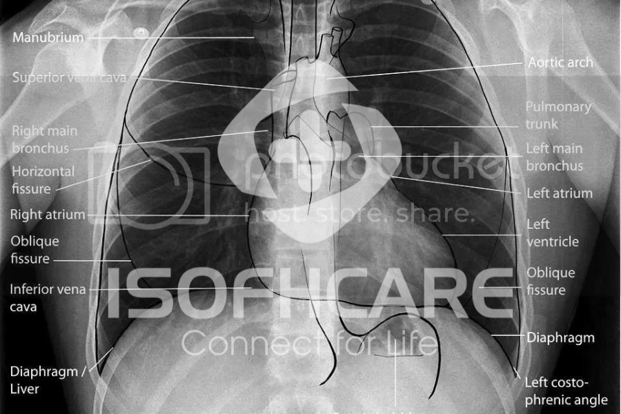 Vì sao phải chụp X-Quang tim phổi?