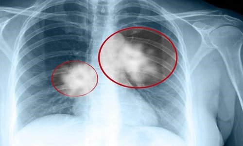 Chụp X quang tim phổi là xét nghiệm gì? Vai trò của chụp X...