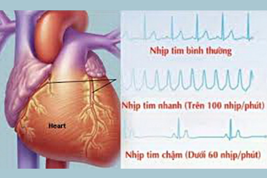 Hở van tim và rối loạn nhịp tim là 2 tổn thương tim thường gặp trong bệnh cơ tim hạn chế