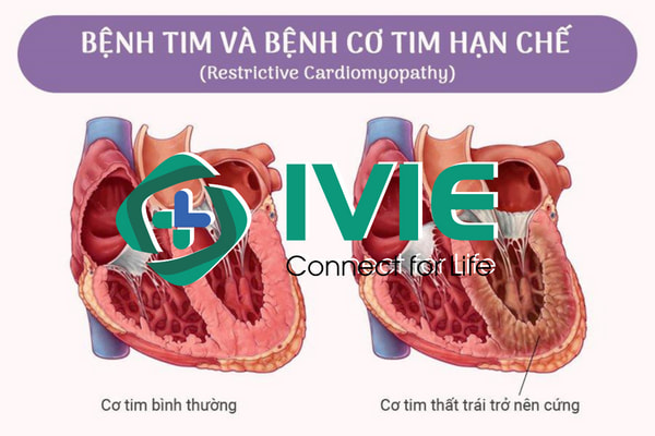 Cơ chế tổn Thương và triệu chứng bệnh cơ tim hạn chế