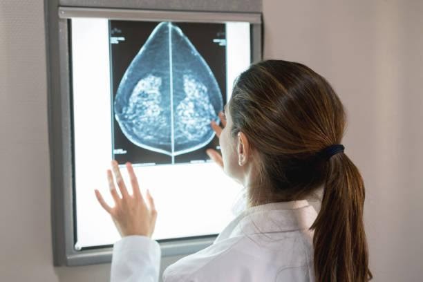 Dấu hiệu nhận biết ung thư vú dễ phát hiện và chính xác