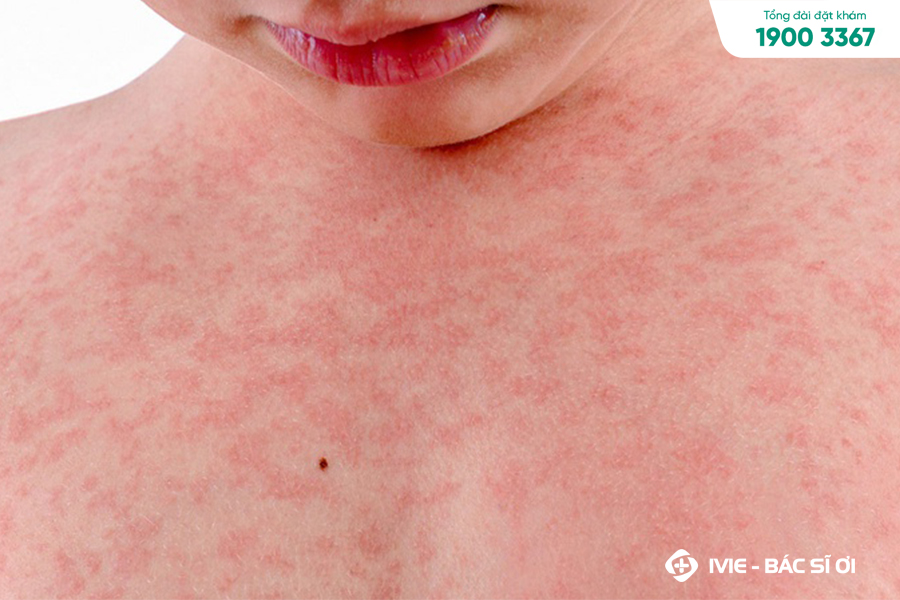 Trẻ mọc răng và nổi mẩn đỏ có dấu hiệu và triệu chứng như thế nào?