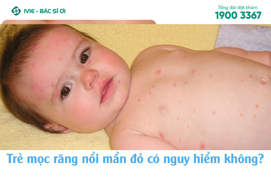 Liệu rằng có nguy hiểm không khi trẻ mọc răng bị nổi mẩn đỏ?