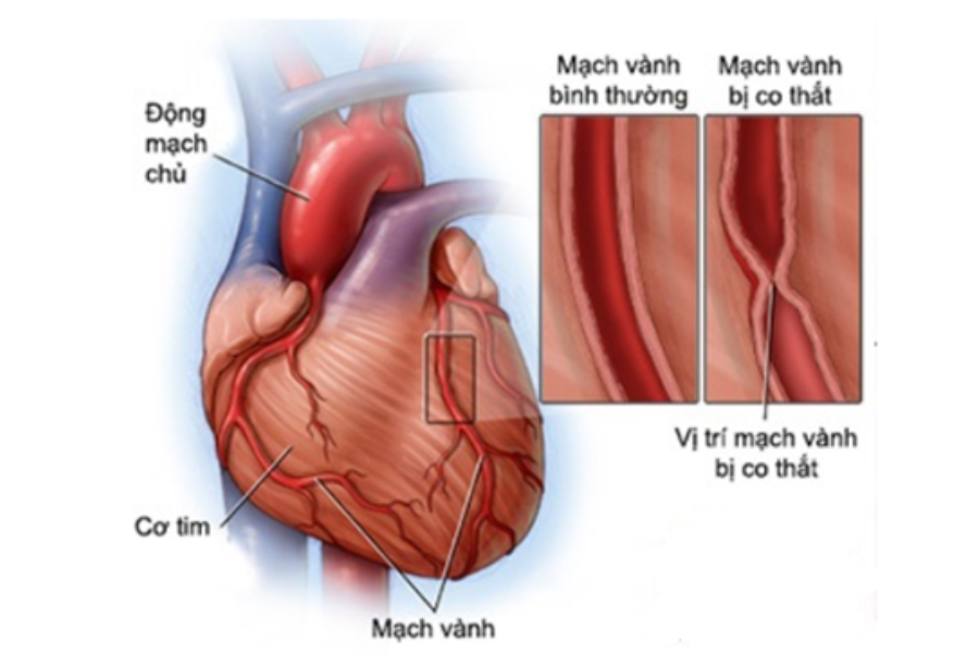 Co thắt động mạch vành, huyết khối động mạch vành hay viêm cơ tim đều có thể xảy ra do sử dụng cocaine
