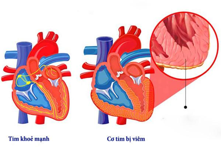 Cơ tim bị viêm làm rối loạn dẫn truyền điện học bình thường của tim