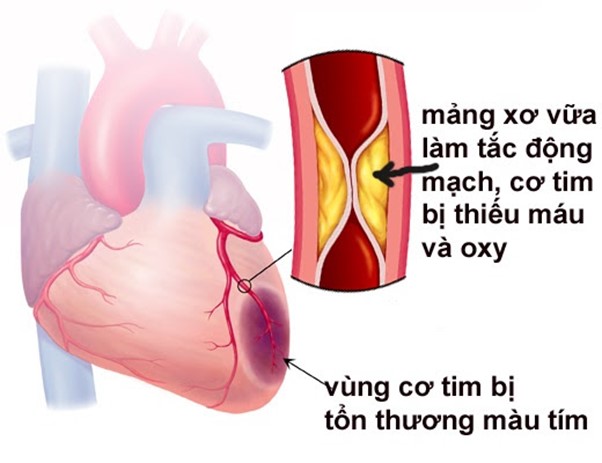                           Cơ tim bị tổn thương trong bệnh nhồi máu cơ tim