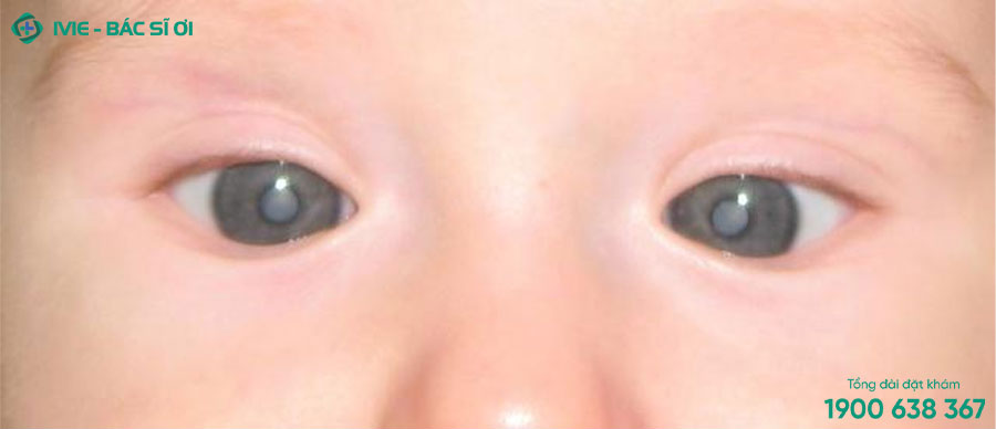 Con ngươi màu trắng đục là dấu hiệu mắt trẻ sơ sinh không bình thường