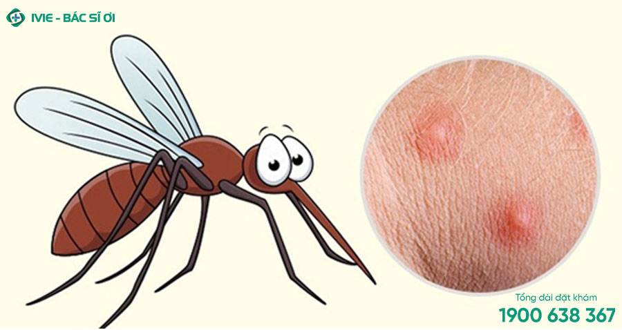 Vết cắn của muỗi thường có kích thước nhỏ và hình dạng đồng đều