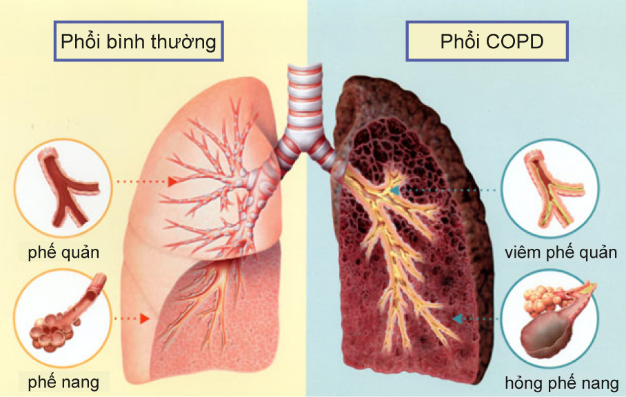 Viêm phổi tắc nghẽn mãn tính (còn được gọi với thuật ngữ COPD) là một trong những bệnh lý hô hấp phổ biến hàng đầu ở nước ta
