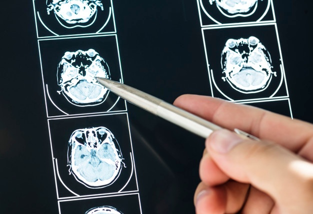 Sự khác nhau giữa chỉ định MRI và CLVT sọ não