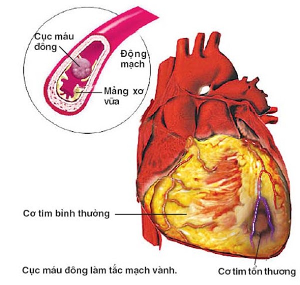 Cục máu đông có thể làm tắc mạch vành - mạch máu nuôi tế bào cơ tim