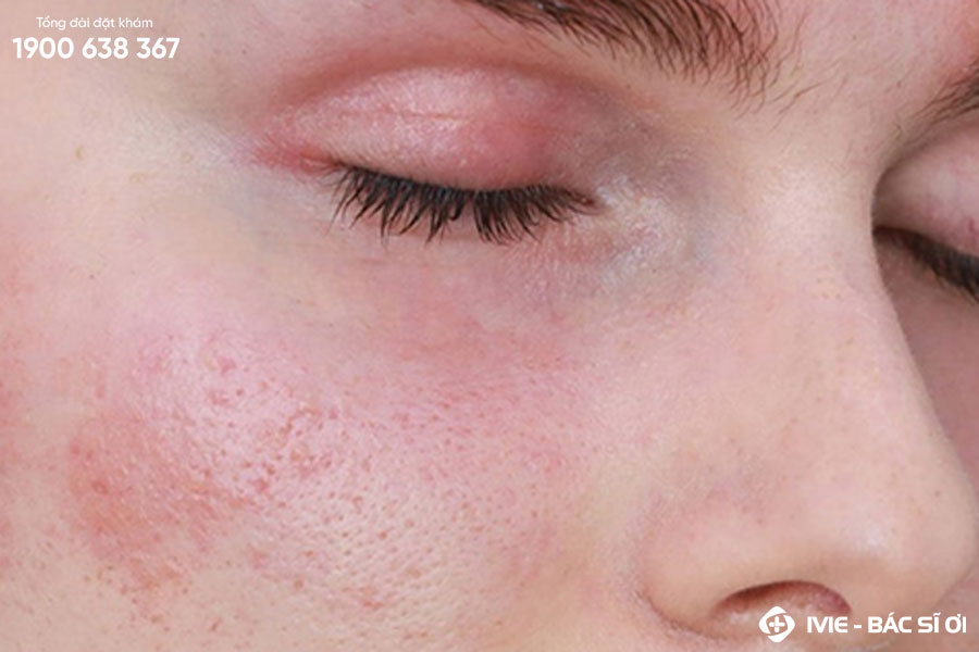 Kích ứng da là tình trạng mà da trở nên nhạy cảm và dễ bị kích thích bởi các tác nhân bên ngoài