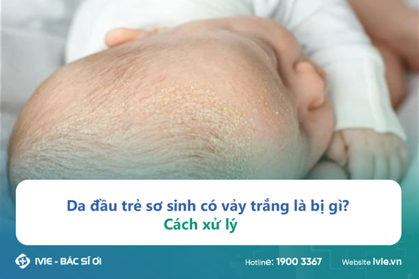 Da đầu trẻ sơ sinh có vảy trắng là bị gì? Cách xử lý