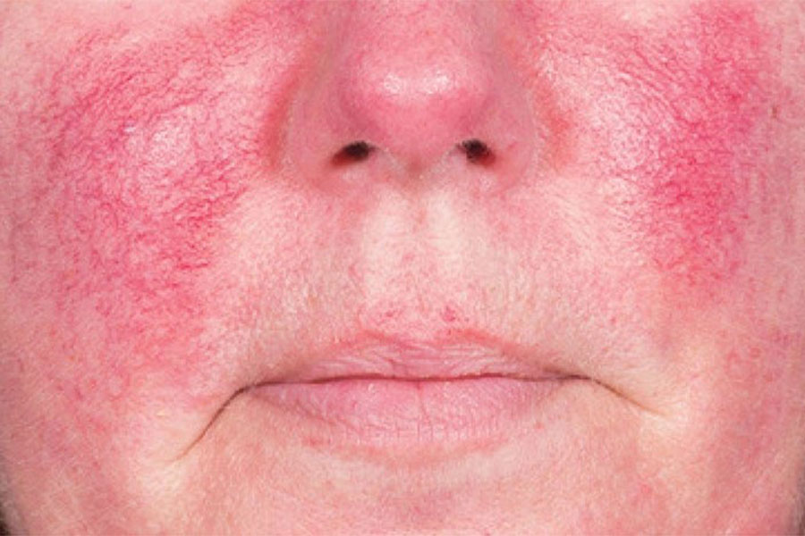 Da mặt bị đỏ và nóng có thể là dấu hiệu cảnh báo viêm da Corticoid