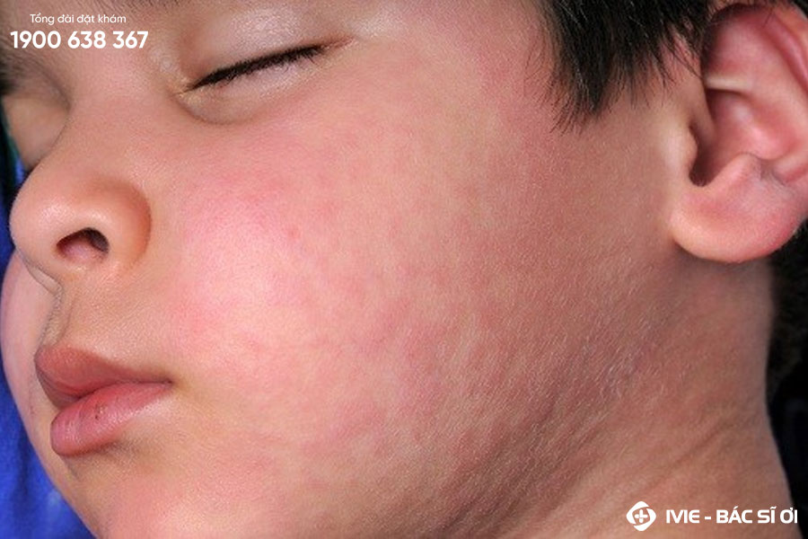 Nổi mề đay có thể là một nguyên nhân gây lên tình trạng da mặt bị dị ứng sần ngứa