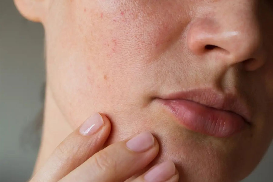Da mặt bị ngứa và nổi mẩn đỏ là hiện tượng gì? Có nguy hiểm không