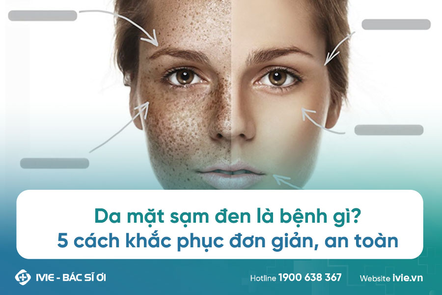 Da mặt sạm đen là bệnh gì? 5 cách khắc phục đơn giản, an...