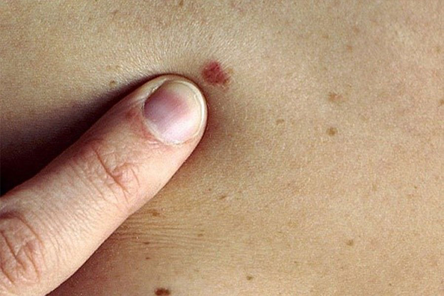 Da nổi mẩn đỏ hỏn ko ngứa hoàn toàn có thể là tín hiệu lưu ý các bệnh ung thư da