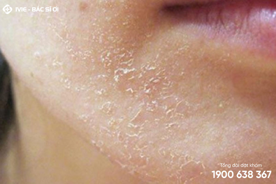 Tróc vảy trắng và ngứa cũng có thể xuất hiện trên da mặt và vùng cổ
