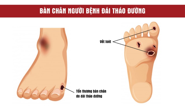 10 lưu ý khi chăm sóc bàn chân đối với người mắc bệnh đái...