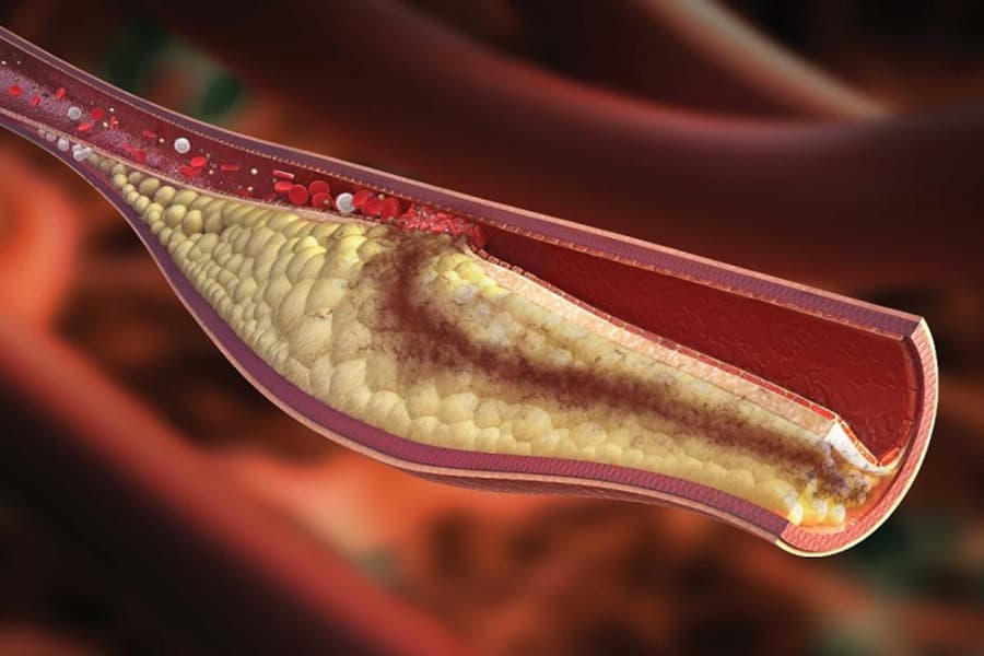 Tăng lipid máu tạo nên các mảng xơ vữa trong lòng mạch