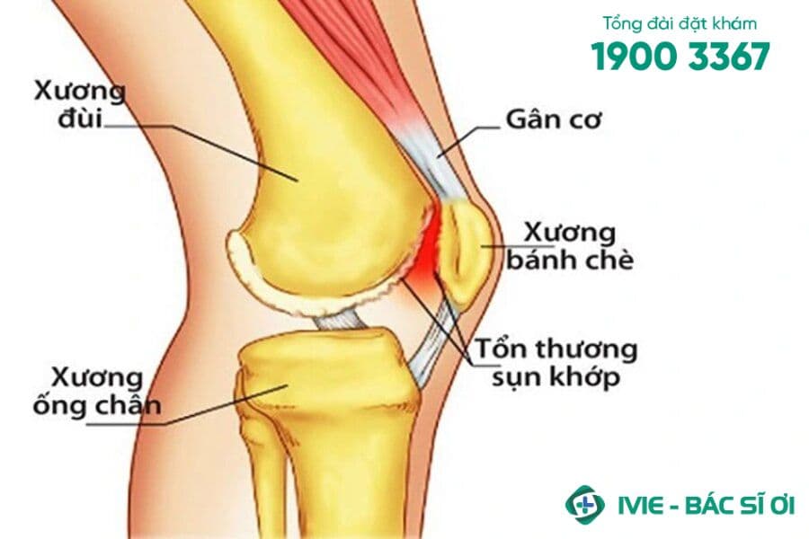 Đau khớp gối khi đứng lên ngồi xuống là do đâu?