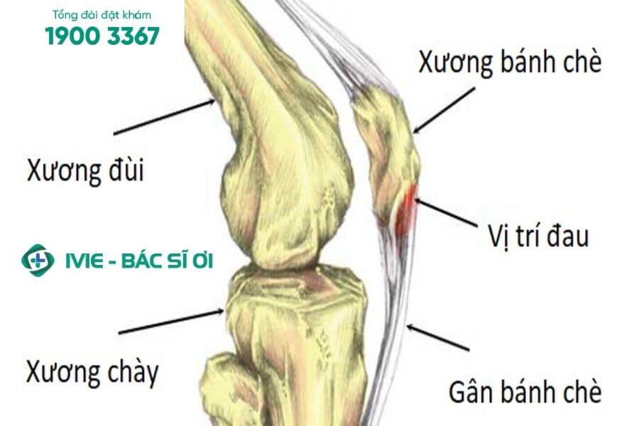 Dấu hiệu của viêm gân bánh chè