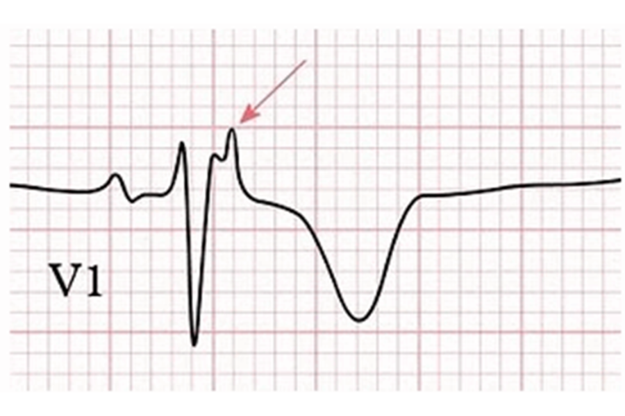 Sóng epsilon (mũi tên đỏ), dấu hiệu điển hình trên người bệnh mắc bệnh cơ tim thất phải gây rối loạn nhịp