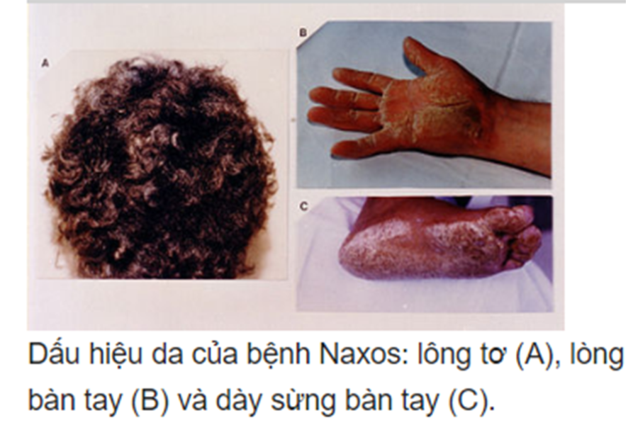 Dấu hiệu trên da của bệnh Naxos