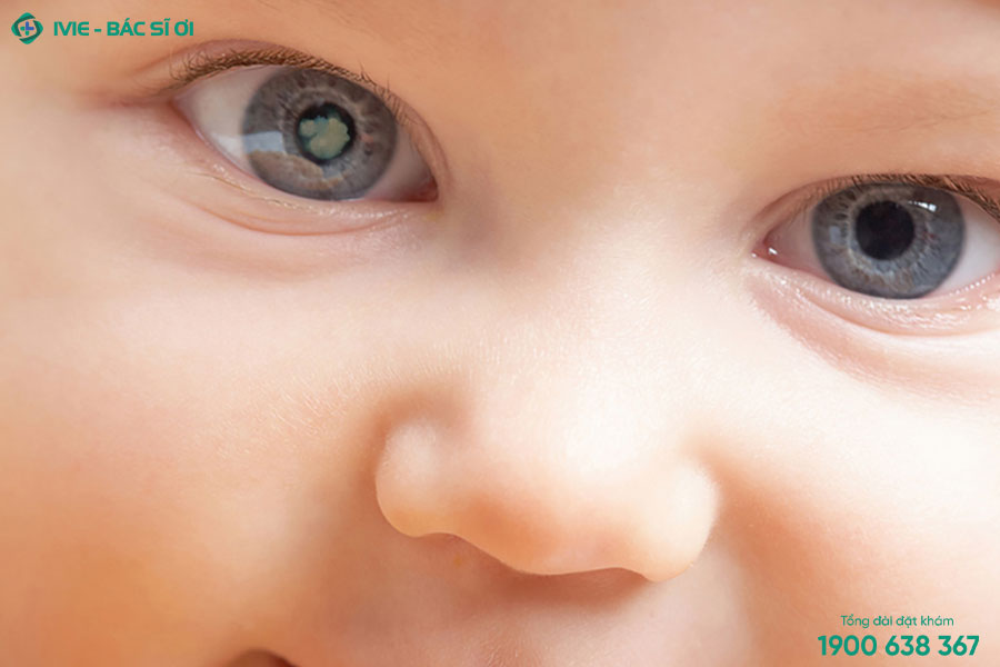 Mắt trẻ sơ sinh không bình thường do bị đục thủy tinh thể