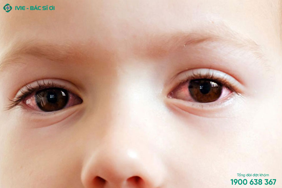 Viêm kết mạc khiến mắt đỏ ở trẻ