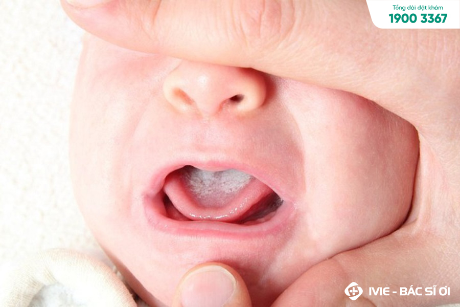 Dấu hiệu, triệu chứng nấm lưỡi ở trẻ sơ sinh