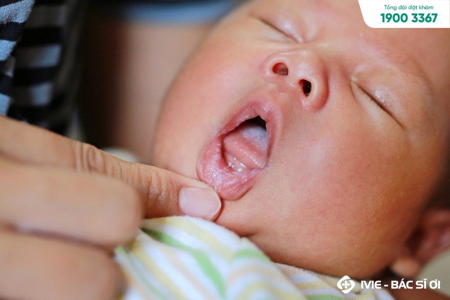 Nguyên nhân gây ra nấm lưỡi ở trẻ sơ sinh