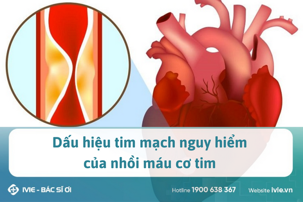 Dấu hiệu tim mạch nguy hiểm của nhồi máu cơ tim