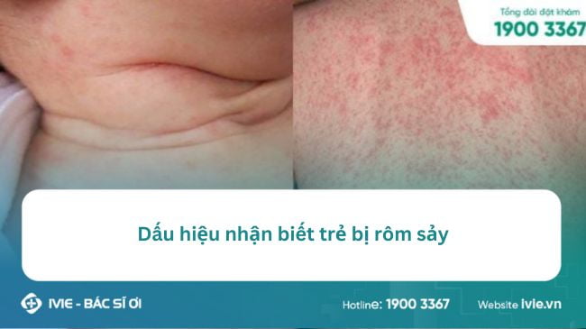 Dấu hiệu nhận biết trẻ bị rôm sảy – Phương pháp điều trị...